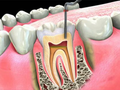 Пломбирование канала зуба