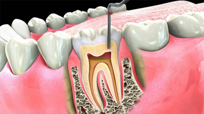 Пломбирование канала зуба