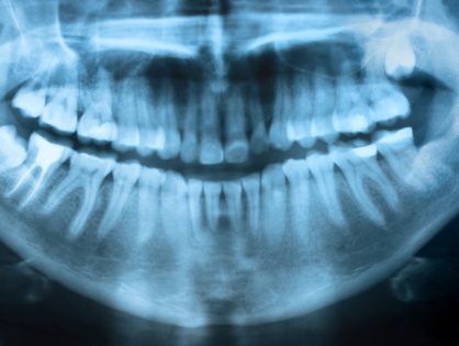 Эндотия - лечение корневых каналов зуба
