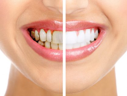 Удаление зубного налета и зубного камня